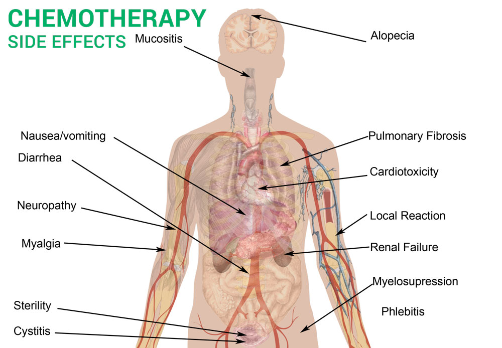 Chemotherapy side effects